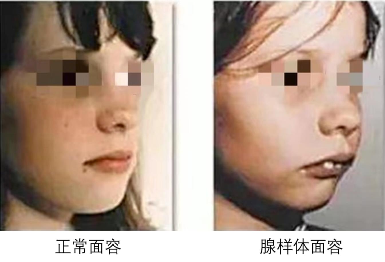 腺样体面容图片对比图，腺样体面容图片